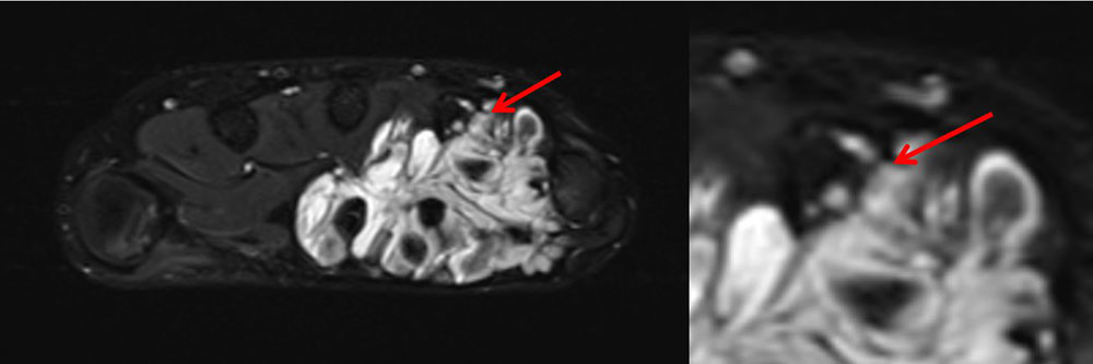MRT – Thromben