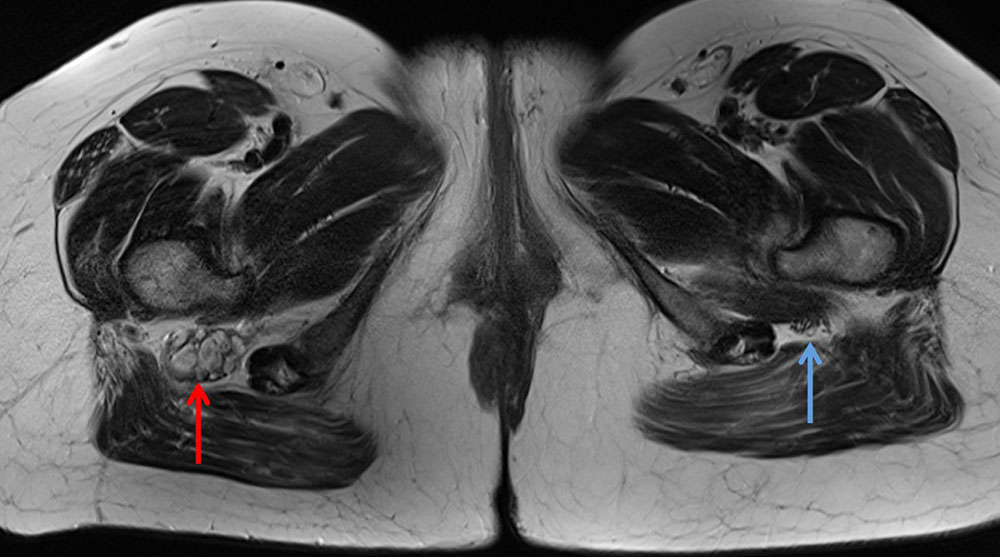 MRT – Nervus ischiadicus