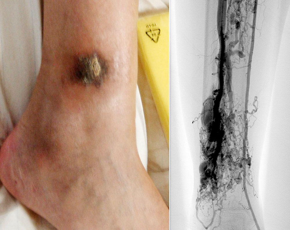 Angiographie – Ulcus an Fuß