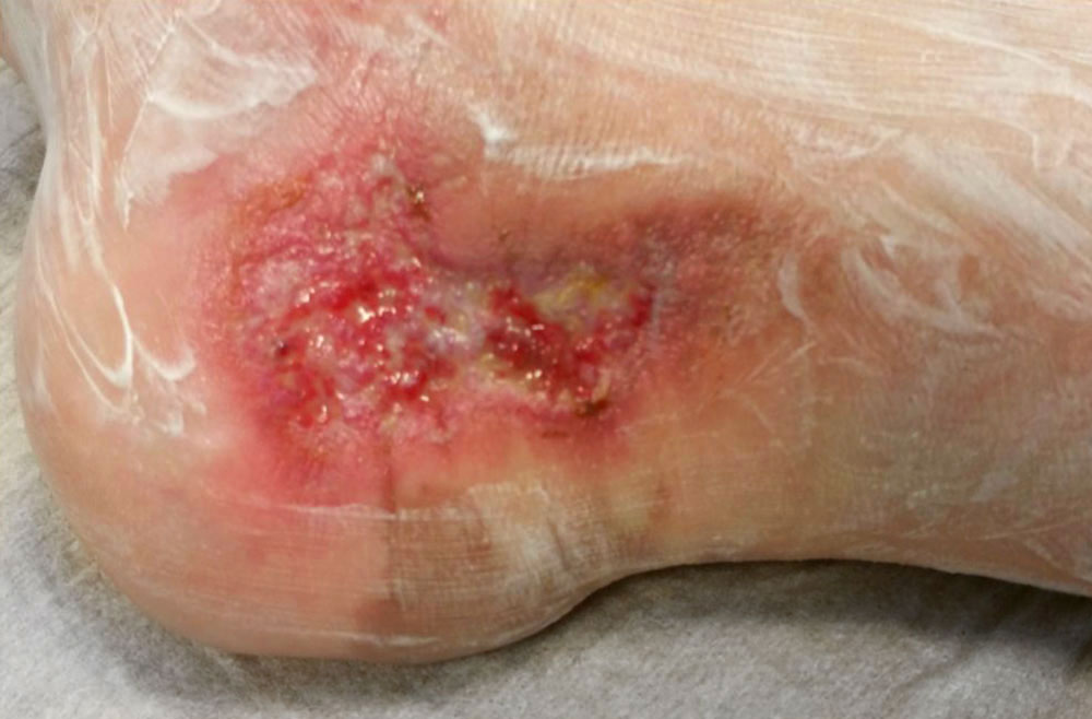 Pseudomonas aerogenosa – Fuß
