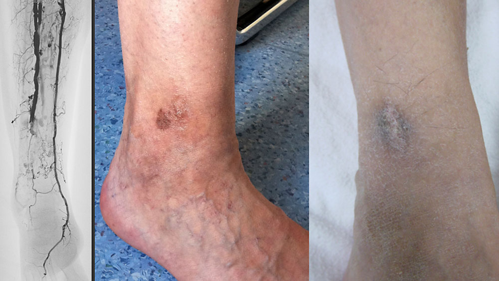 Verschluss der AVM durch Embolisation