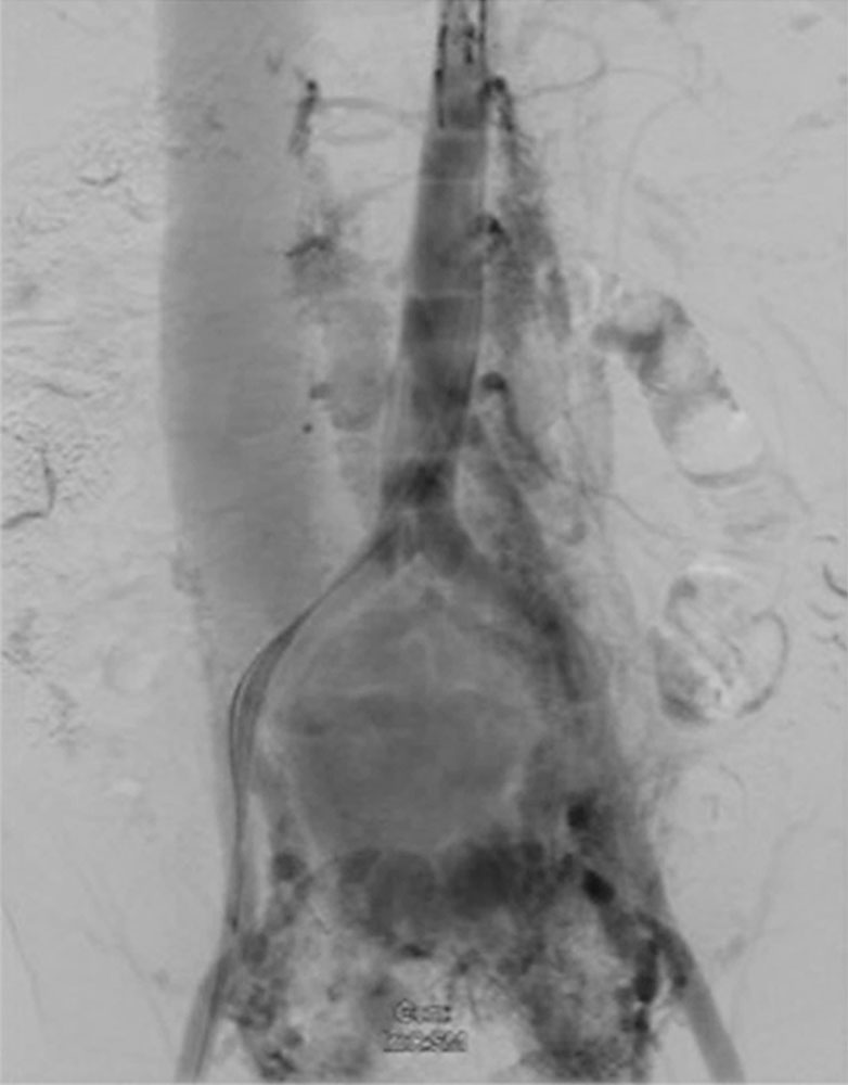 DSA – Riesige abdominelle arteriovenöse Malformation im Becken