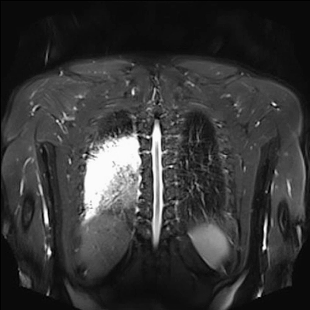 MRT – Pneumonie bei Patient mit arteriovenöser Malformation