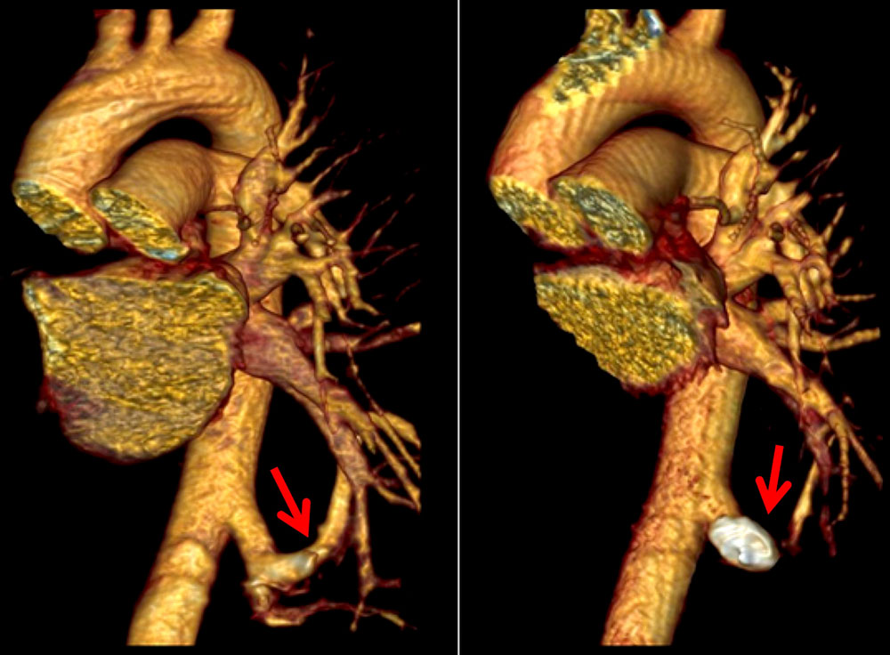 Angeborene arteriovenöse Fistel