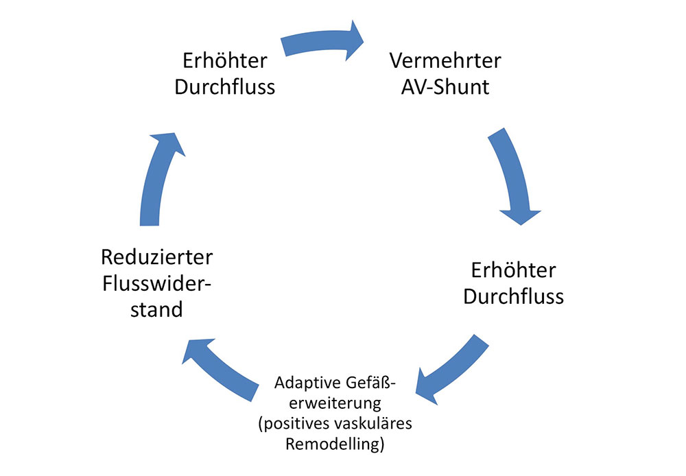 Grafik – Circulus vitiosus bei arteriovenöser Malformation