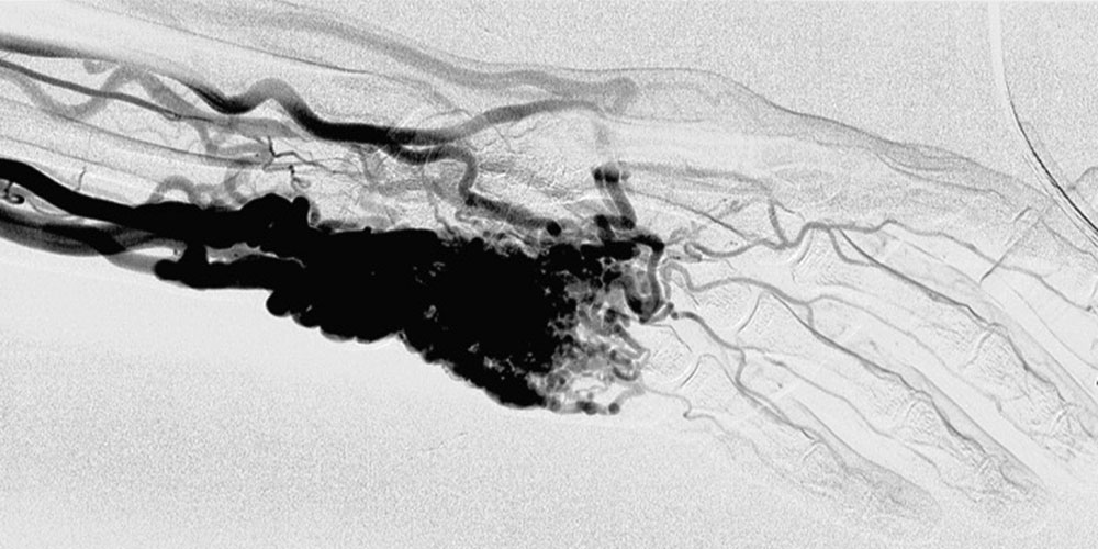 Digitale Subtraktionsangiographie bei arteriovenöser Malformation an der linken Hand