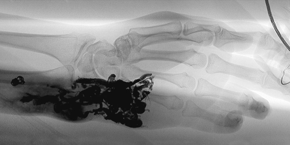 Embolisation einer arteriovenösen Malformation an der Hand