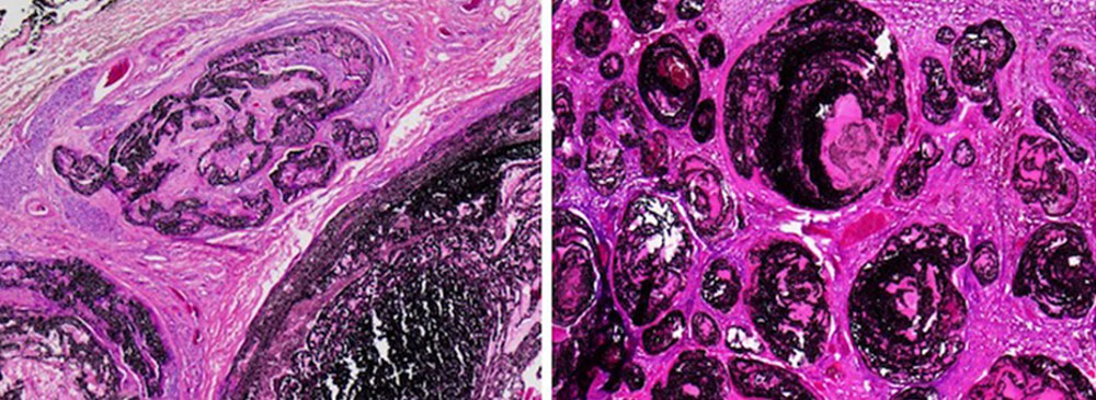 Histologisches Beispiel einer arteriovenösen Malformation die vor der Operation