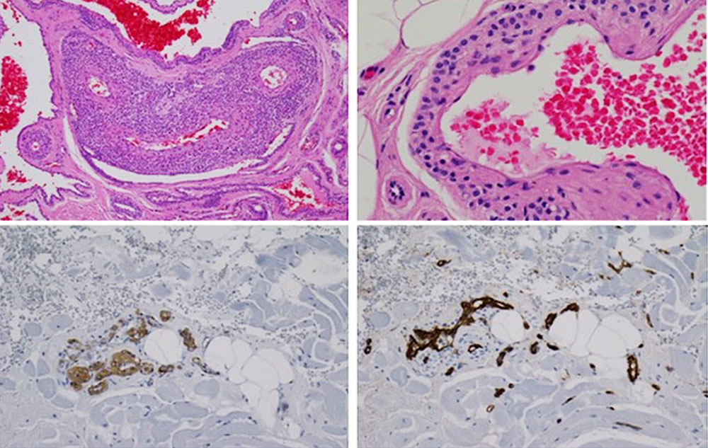 Histologisches Beispiel einer glomuvenösen Malformation