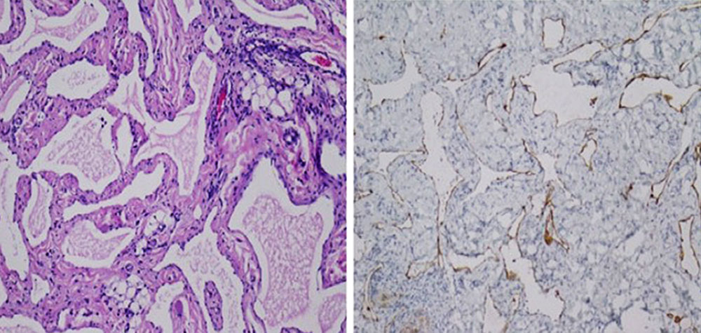 Histologisches Beispiel einer lymphatischen Malformation