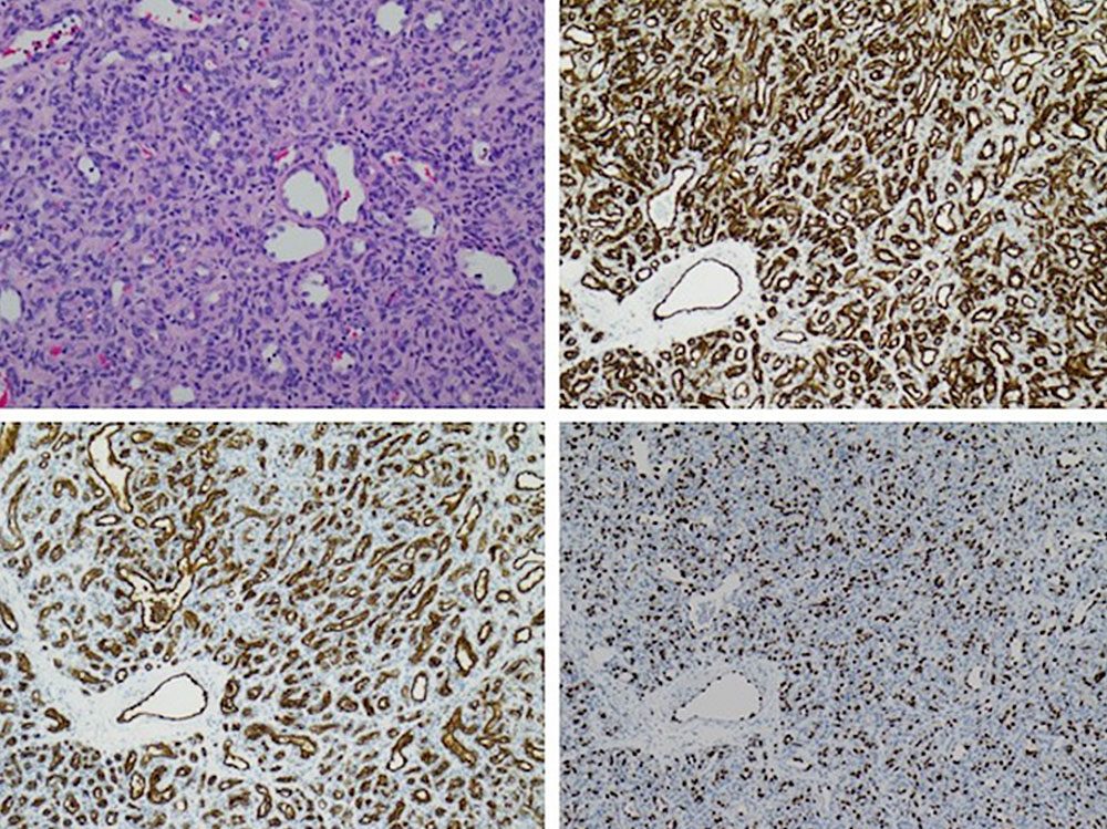 Histologisches Beispiel eines infantilen Hämangioms