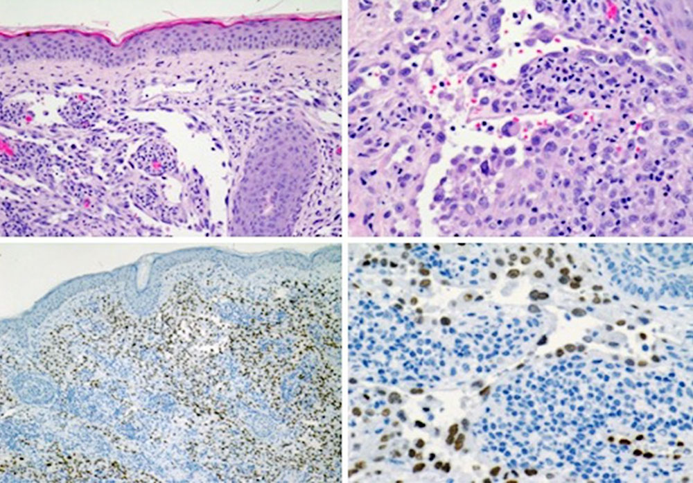 Histologie der Angiosarkome