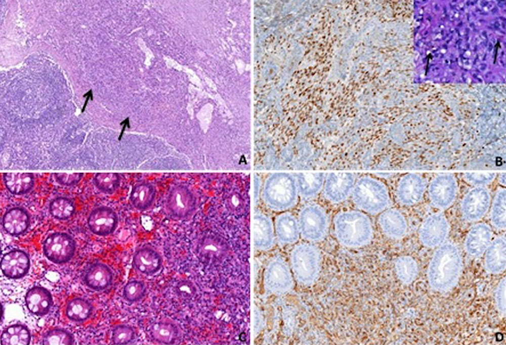 Histologisches Beispiel eines Kaposisarkoms