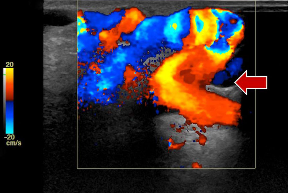 Farbkodierte Duplex-Sonographie (FKDS) einer arteriovenösen Malformation