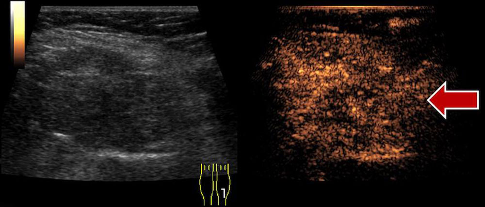 Sonographie einer venösen Malformation