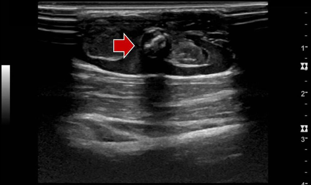 Phlebolith in einer venösen Malformation