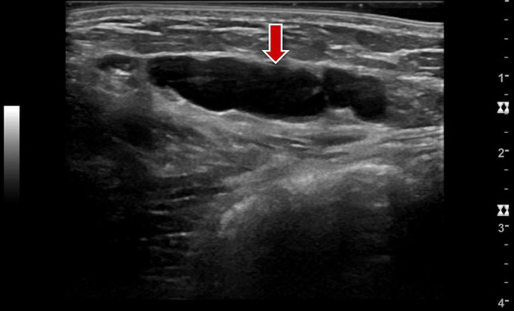 Ultraschallbefund einer makrozystischen lymphatischen Malformation