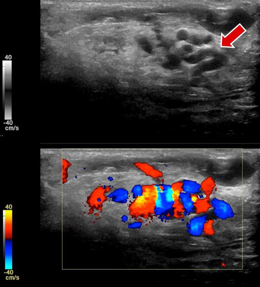 Arteriovenöse Malformation an Hand