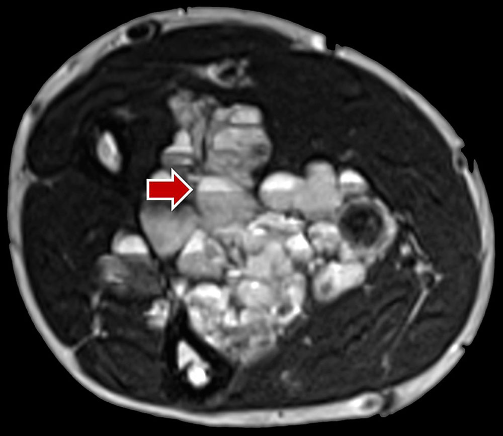 Venöse Malformation in Unterarm