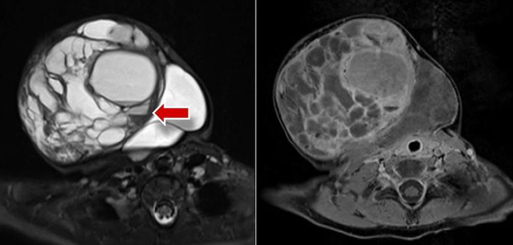 MRT – Makrozystische lymphatische Malformation