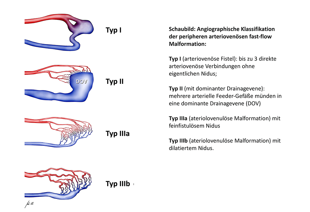 Klassifikation der peripheren arteriovenösen fast-flow Malformation