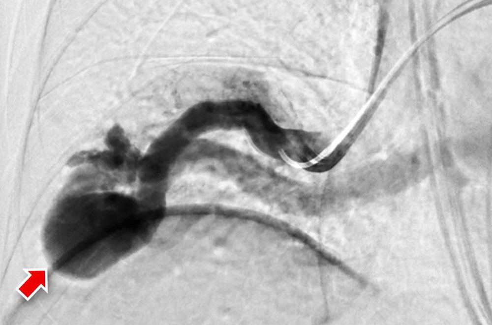 Arteriovenöse Fistel bei Morbus Osler
