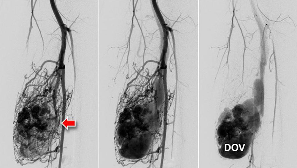 DSA einer arteriovenösen Malformation