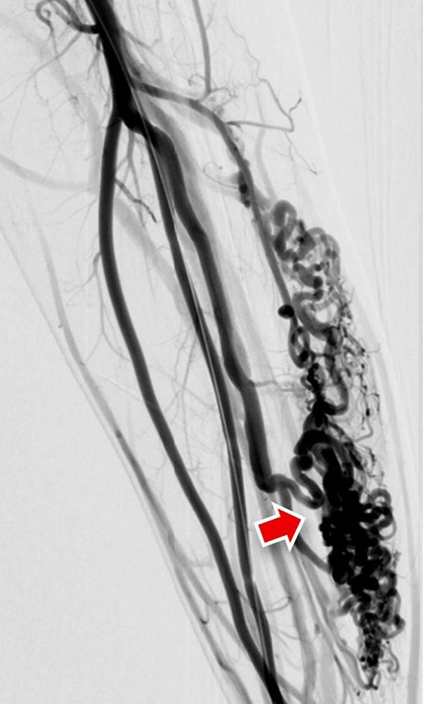 DSA einer arteriovenösen Malformation