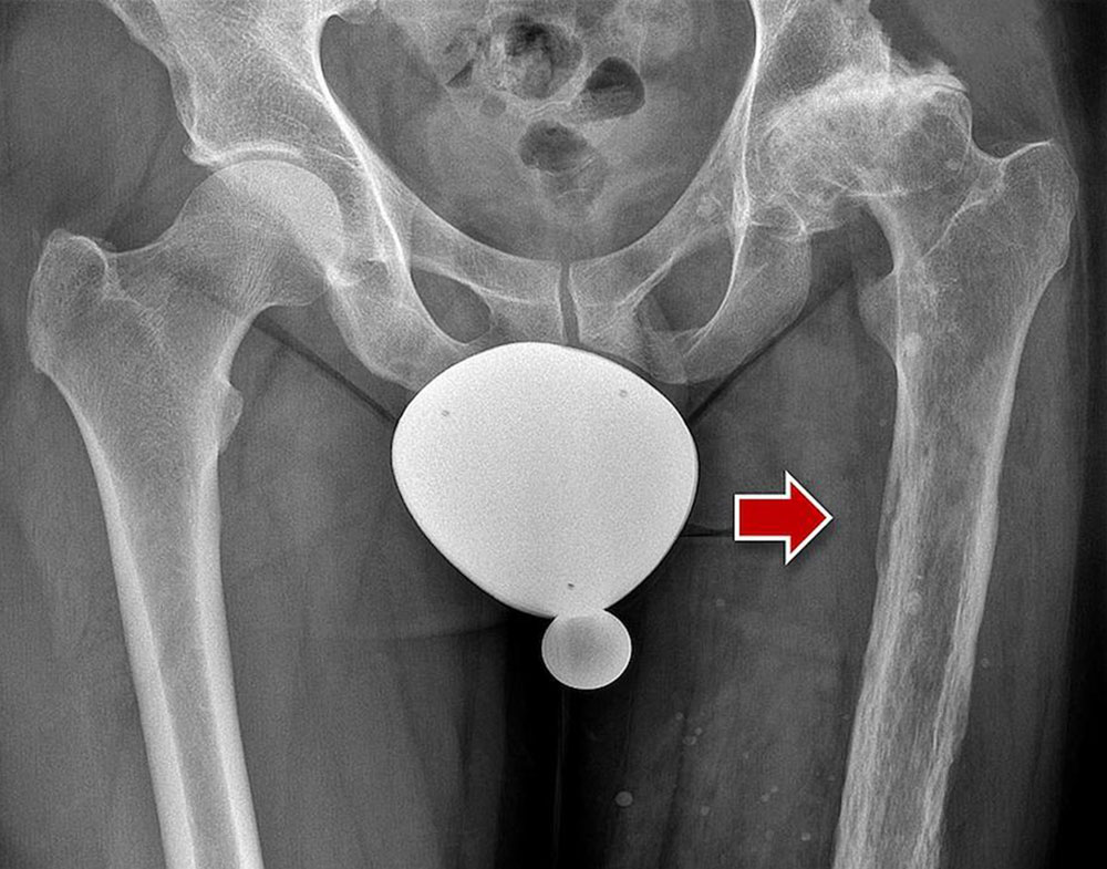 Venöse Malformation an Bein