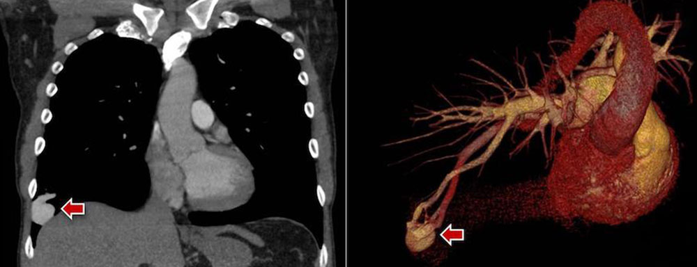 Computertomographie-Angiographie einer pulmonalen AV-Malformation