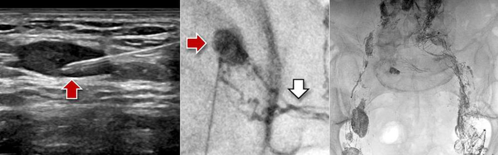 Sonographische Punktion eines Leistenlymphknotens
