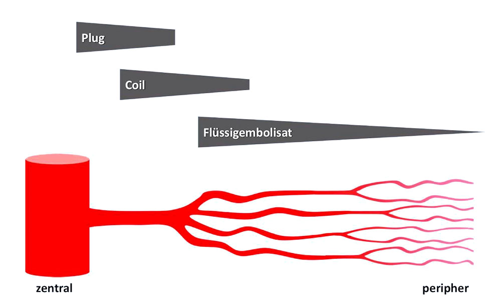 Verschiedene Embolisationsmaterialien
