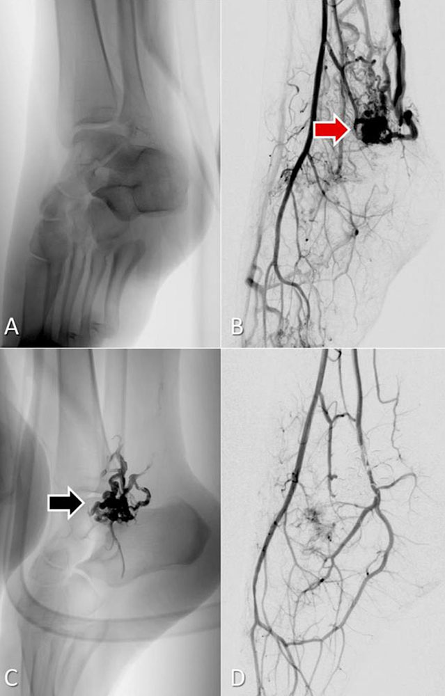Embolisation mit Flüssigembolisat