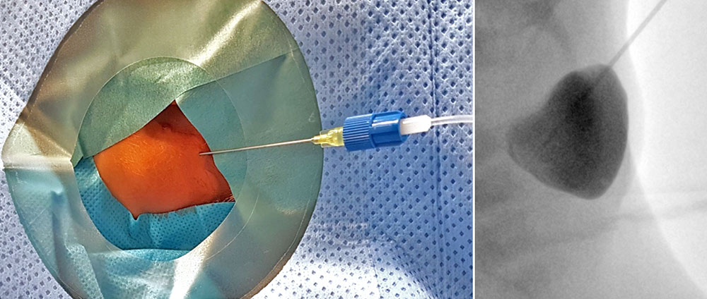 Sklerotherapie makrozystischer lymphatischer Malformation