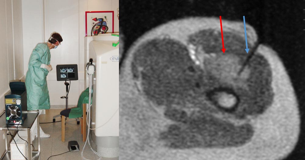 MRT-gesteuerte laser-induzierte interstitielle Thermotherapie