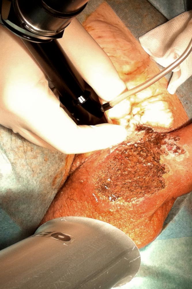 CO2-Lasertherapie