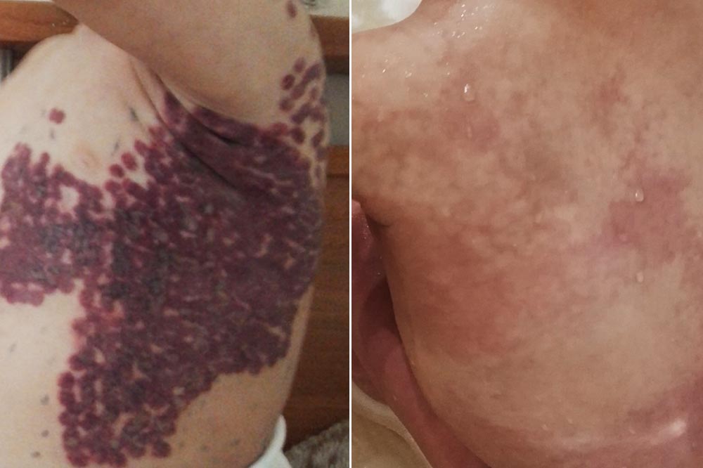 Purpura nach der Lasertherapie einer kapillären Malformation