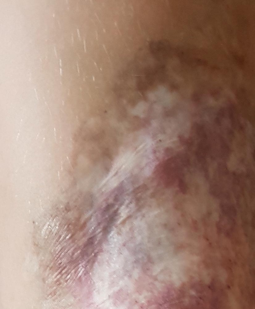 Hautatrophie nach multiplen Lasertherapien einer kapillären Malformation