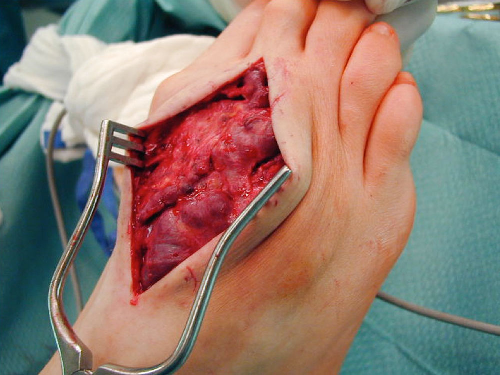 Intraoperativer Situs in Blutsperre bei venöser Malformation