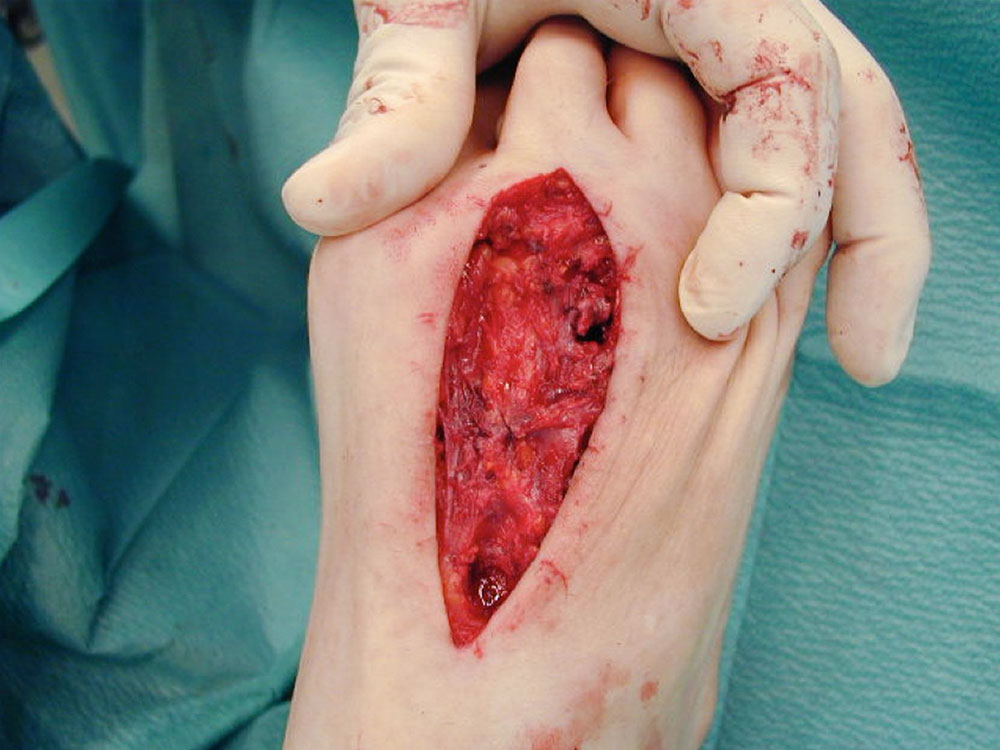 Resektion der großflächigen venösen Malformation