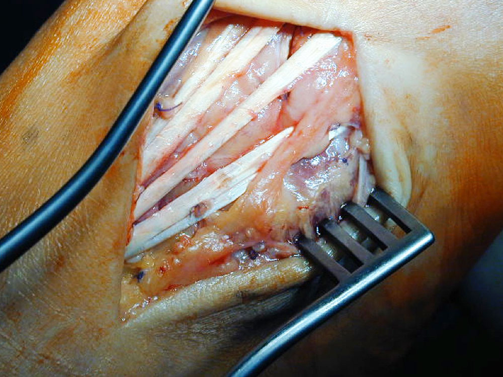 Arteriovenöse Malformation am Fußrücken