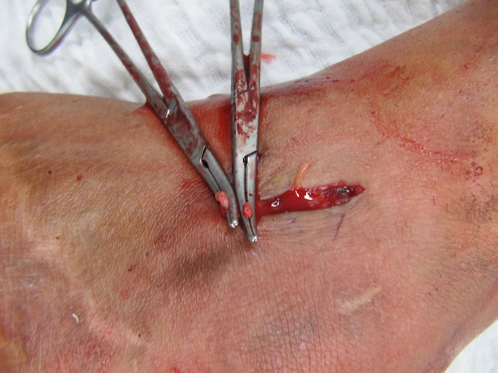 Chirurgischer Situs – Venöse Malformation
