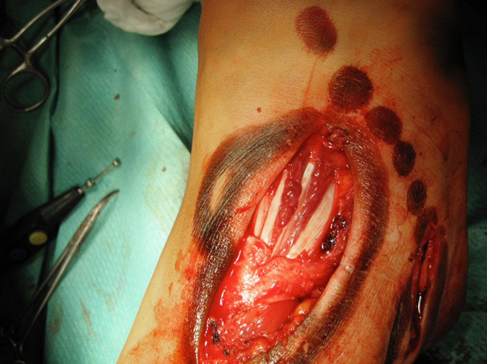 Op-Situs – Venöse Malformation