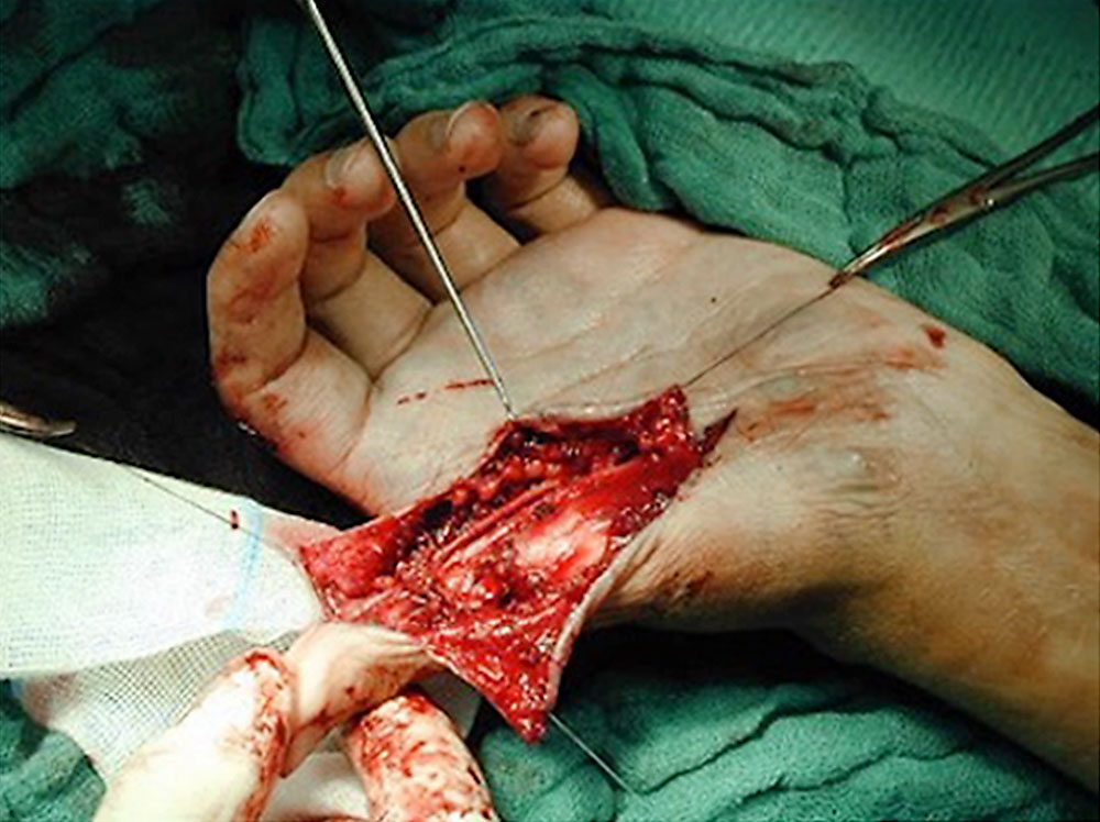 Op-Situs nach Resektion der arteriovenösen Malformation
