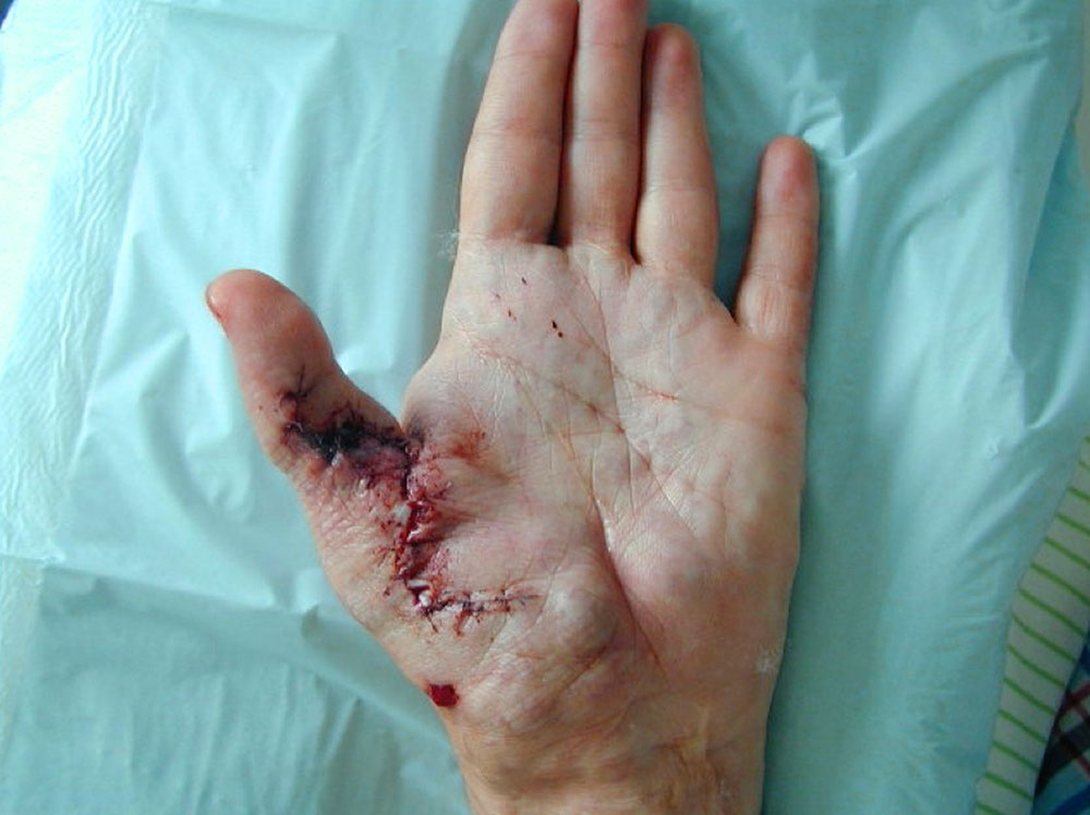 Aufnahme nach Resektion der ausgedehnten arteriovenösen Malformation