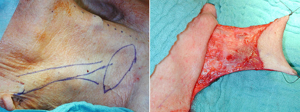Platysma-Lappen