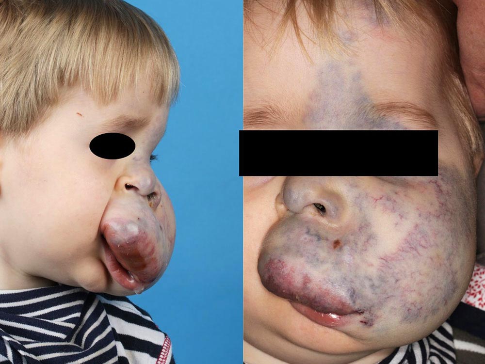 Venöse Malformation – Gesicht