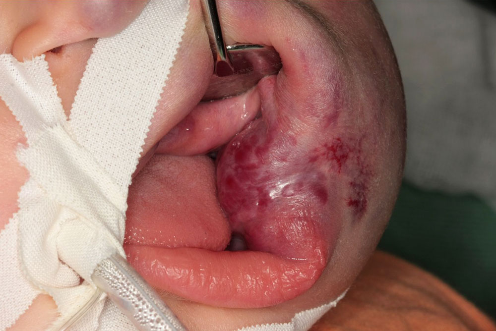 Venöse Malformation nach Oeration