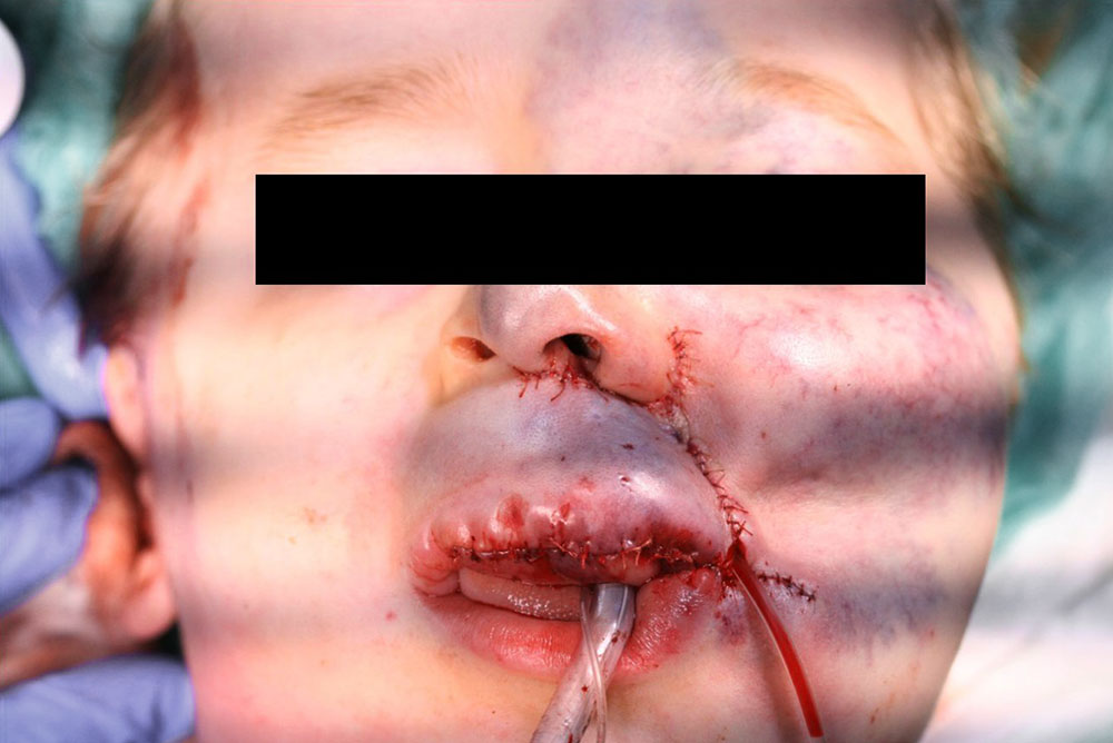 Venöse Malformation nach zweiter Operation