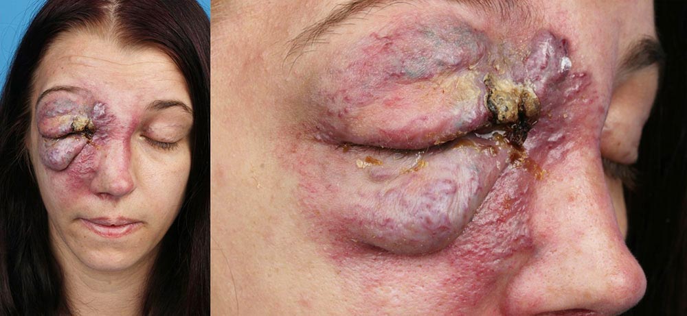 Arteriovenöse Malformation vor Operation